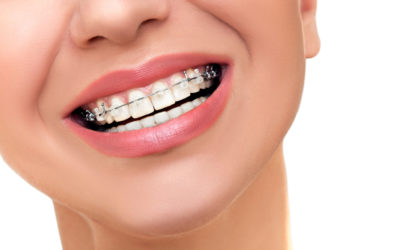 Diferencias entre ortodoncia tradicional y método invisible